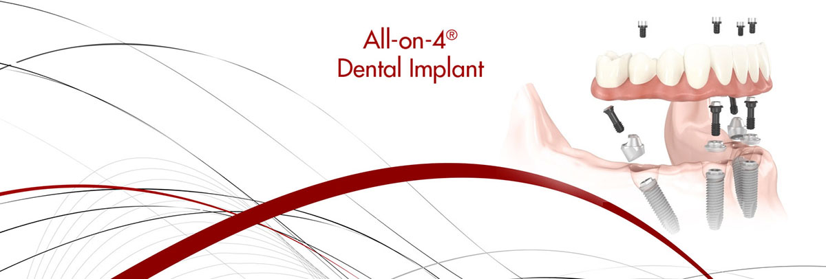 San Juan Capistrano All-on-4 Dental Implants