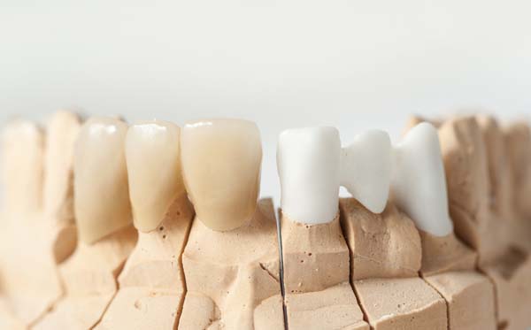 Dental Bridges Can Replace Missing Teeth