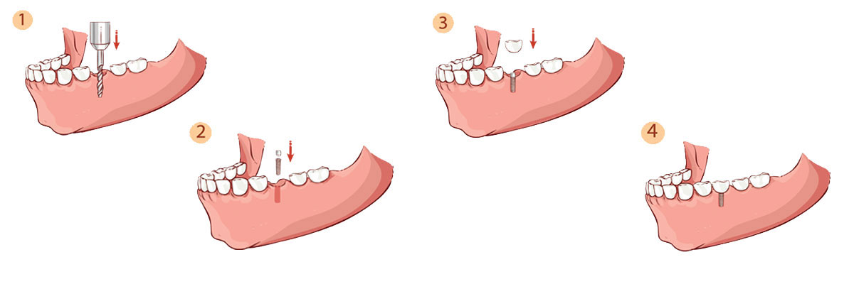 San Juan Capistrano Dental Implant Restoration