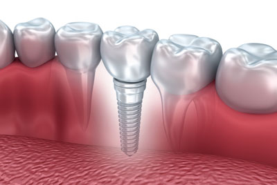 Speak With An Implant Dentist If You Are Tired Of Wearing Dentures