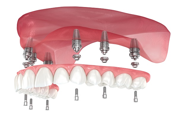 Common Questions About Implant Supported Dentures