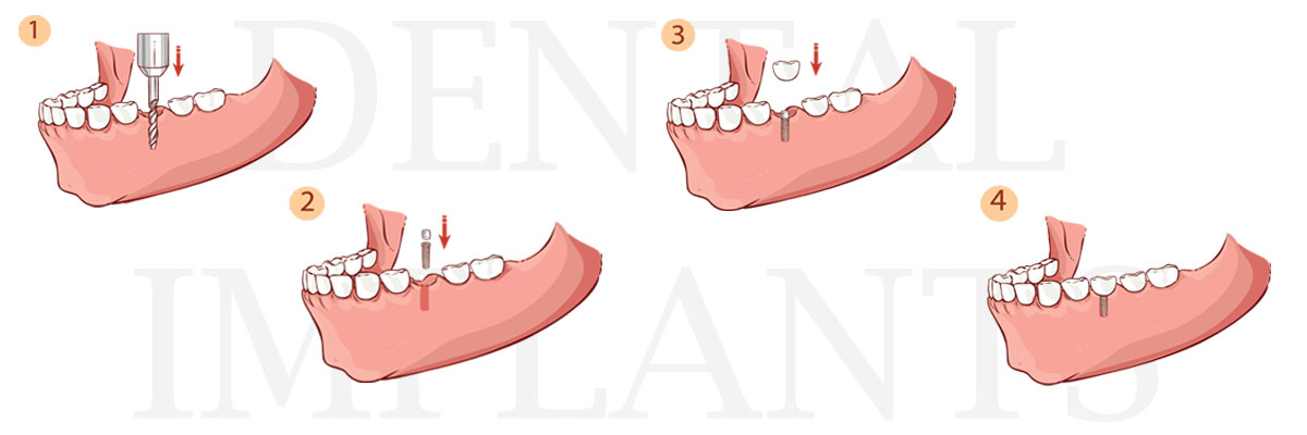 San Juan Capistrano The Difference Between Dental Implants and Mini Dental Implants