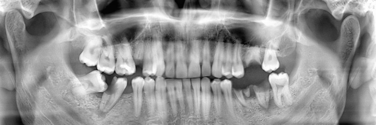 San Juan Capistrano Options for Replacing Missing Teeth